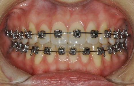 传统正畸与烤瓷牙矫正牙齿的区别